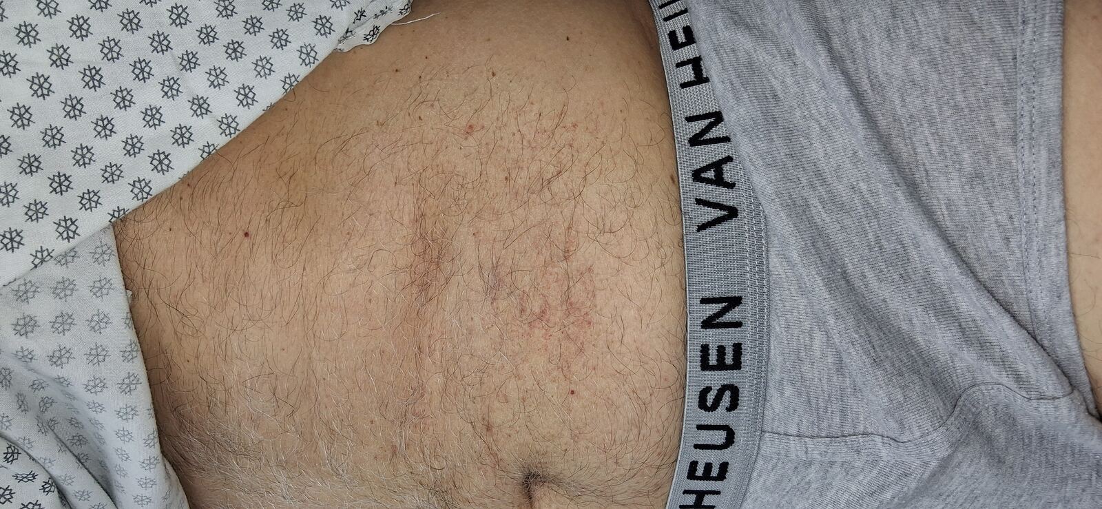 Capilaritis abdominal y xerosis: imagen antes