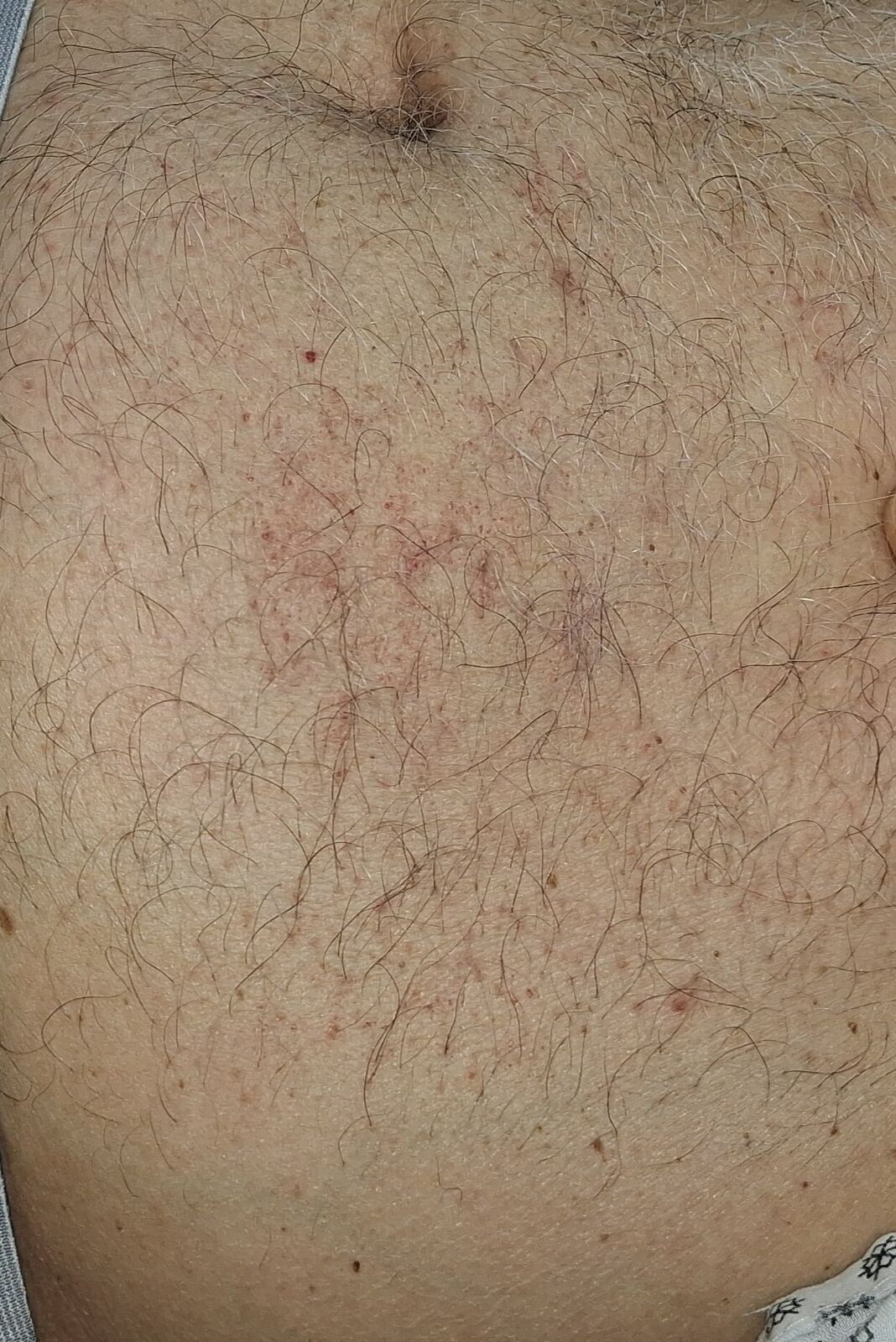 Caso clínico de Capilaritis abdominal y xerosis