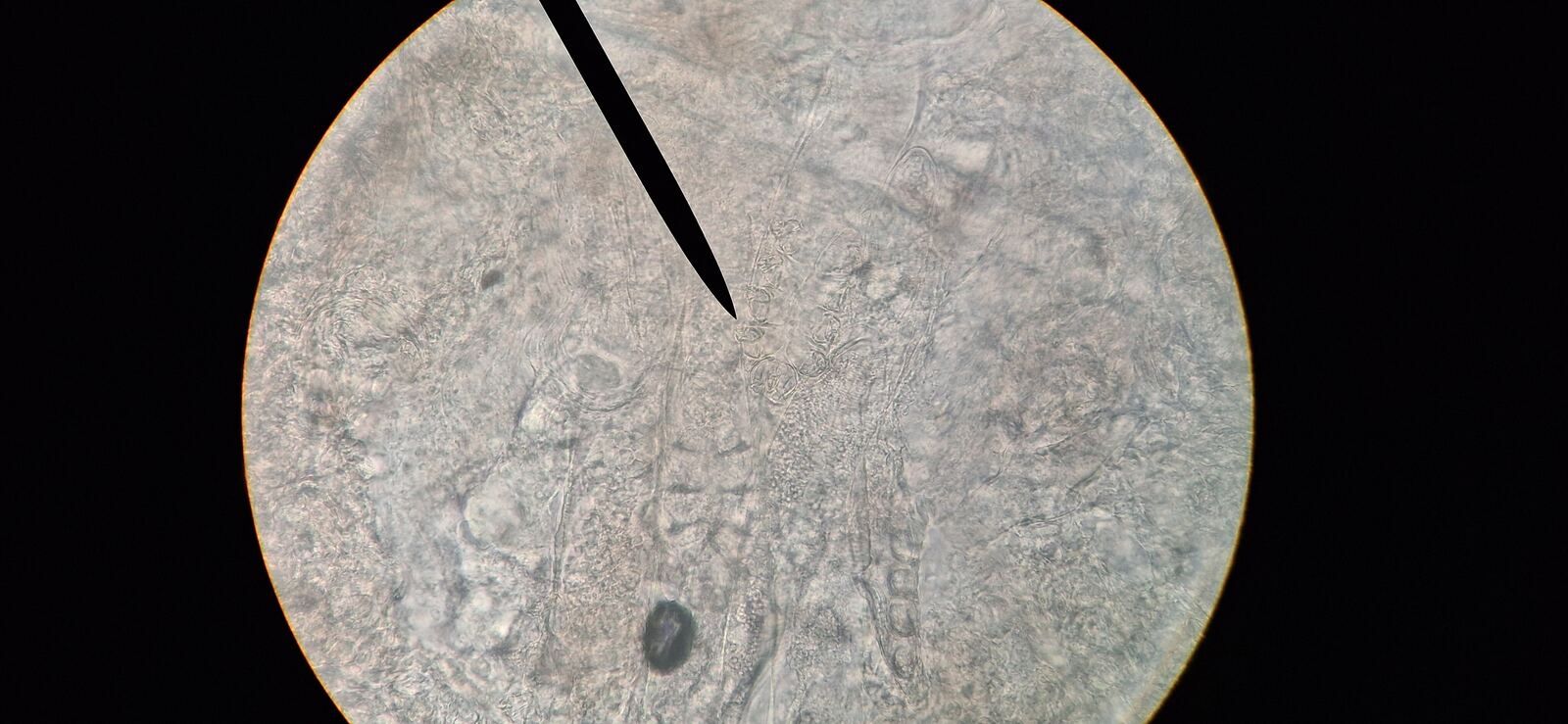 Demodex y dermatitis seborreica: imagen antes