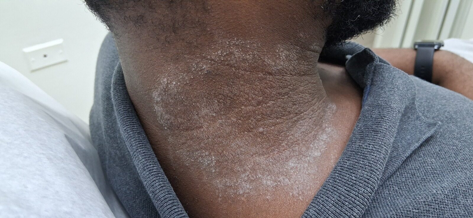 Dermatitis por contacto: imagen antes