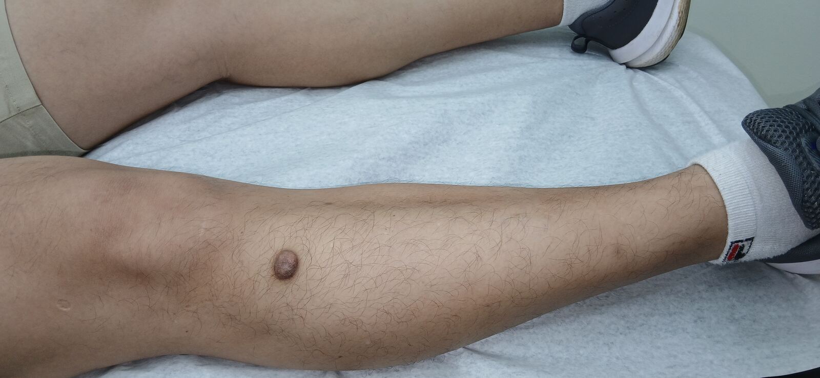 Dermatofibroma y queloide: imagen antes