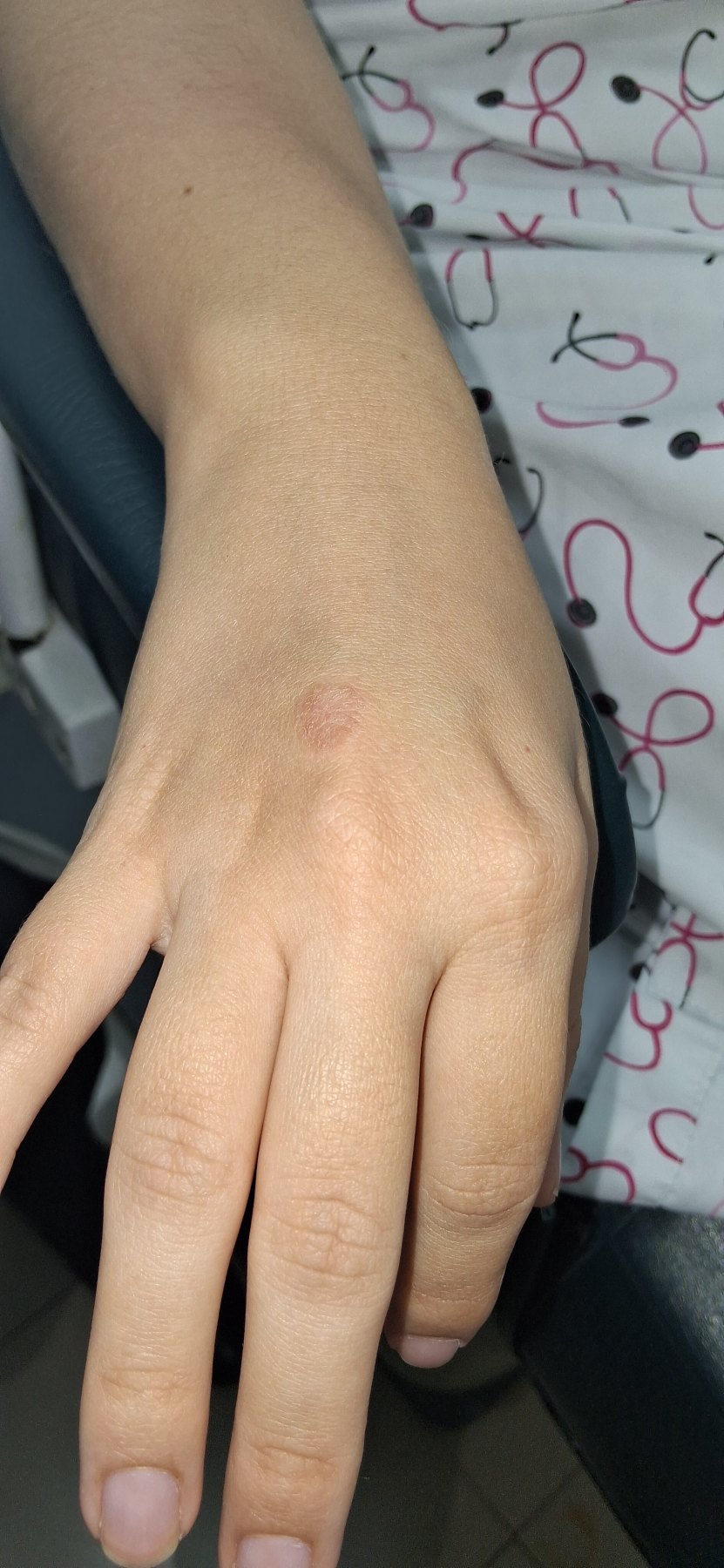 Eczema numular vs tiña corporis: imagen antes