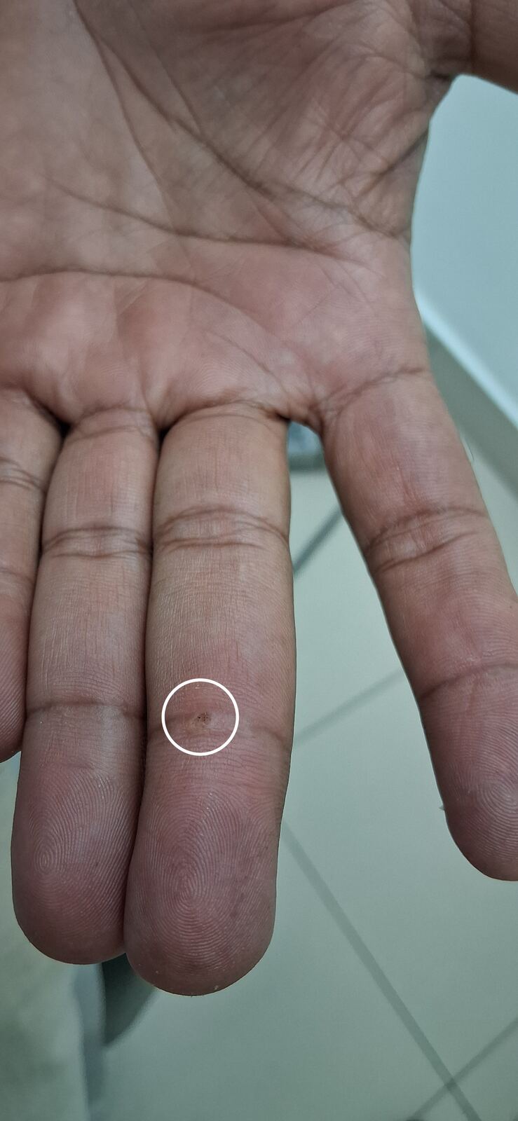 Fibroqueratoma vs verruga: imagen antes