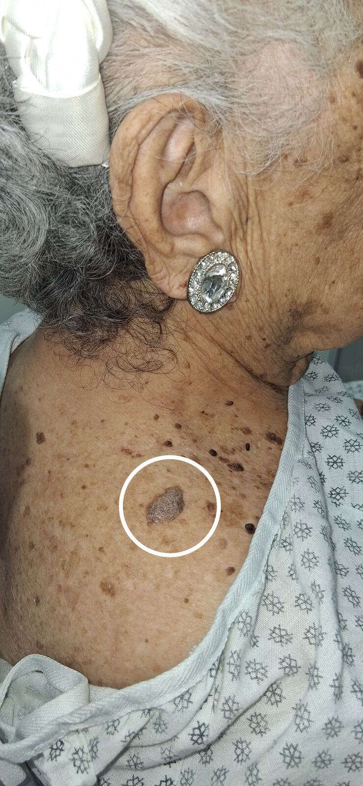 Caso clínico de Melanoacantoma