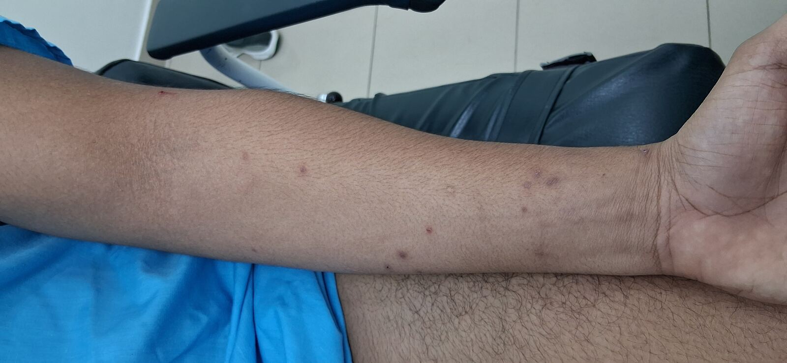 Molusco contagioso: imagen después