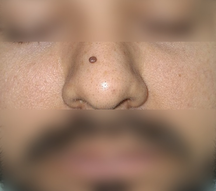 Caso clínico de Nevus pedunculado
