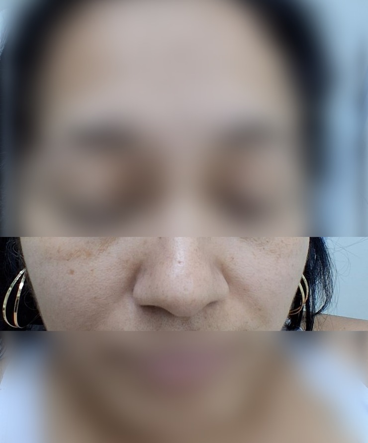 Nevus vs carcinoma basocelular: imagen antes