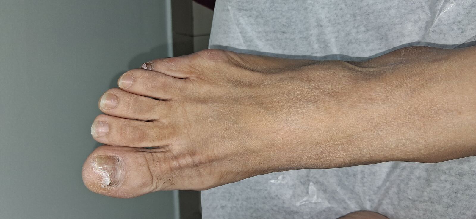 Onicomicosis en manos y pies: imagen antes