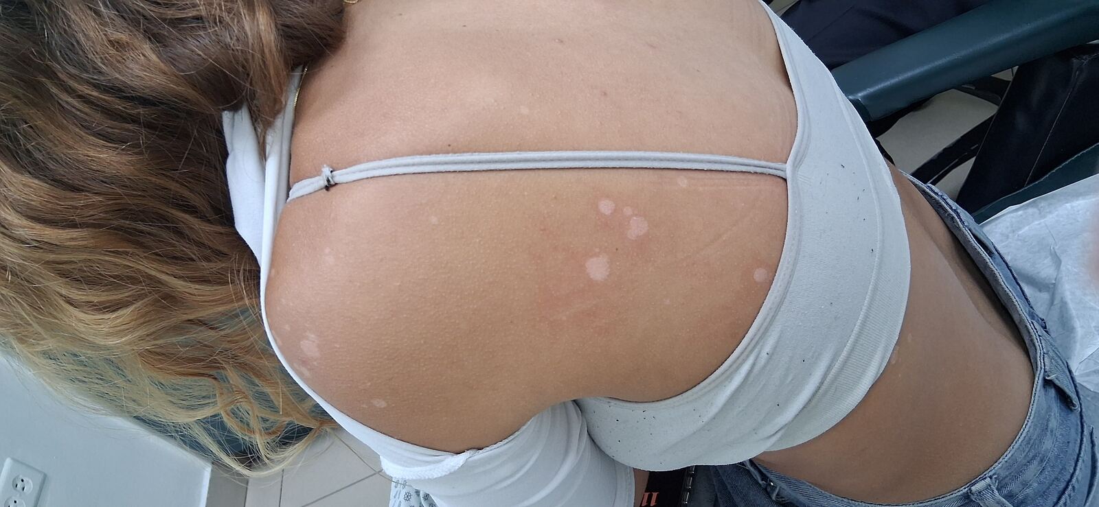 Pitiriasis versicolor e hipomelanosis guttata: imagen antes