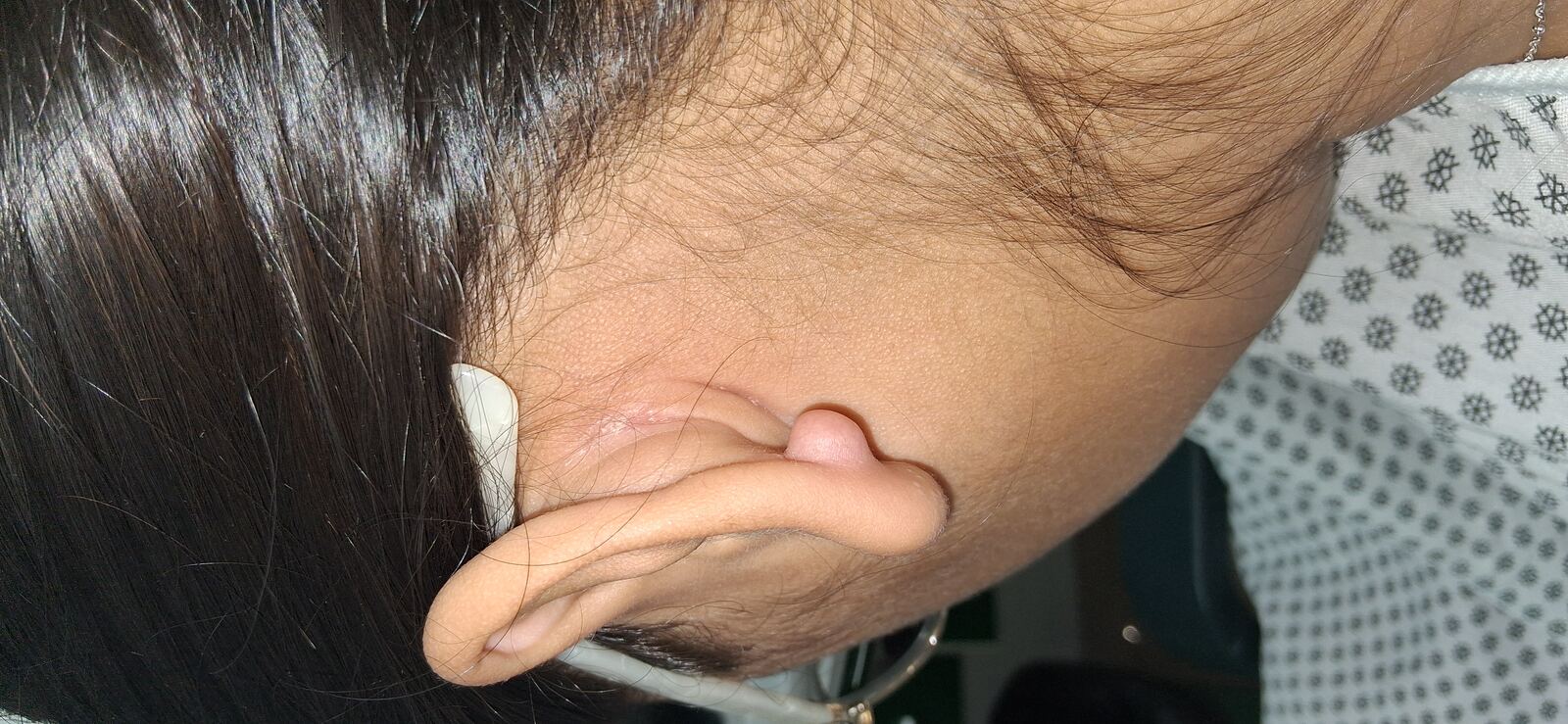 Queloide: imagen antes