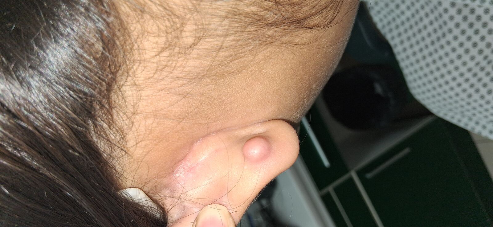 Queloide: imagen después