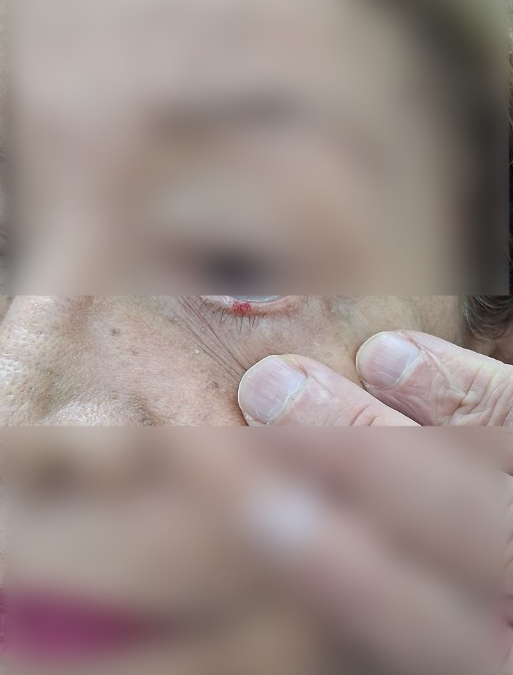 Queratosis actínica: imagen después