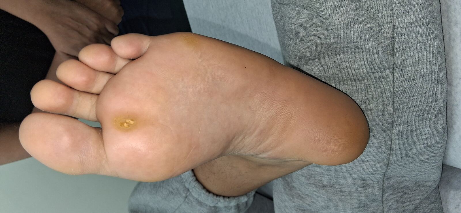 Verruga plantar: imagen antes