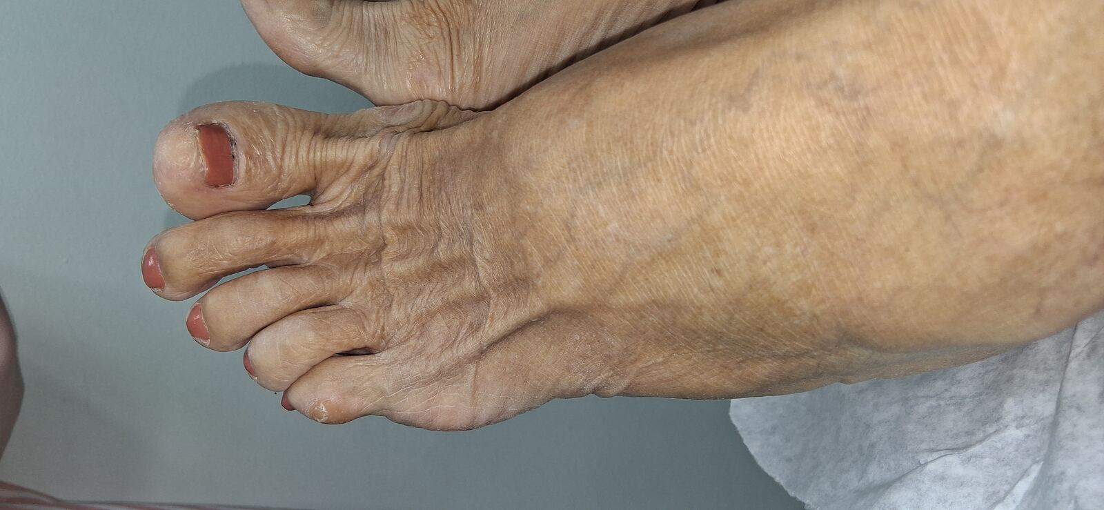 Xerosis: imagen antes